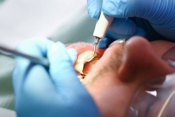 Best Emergency Dental Care for Broken or Chipped Teeth in Enochville, NC